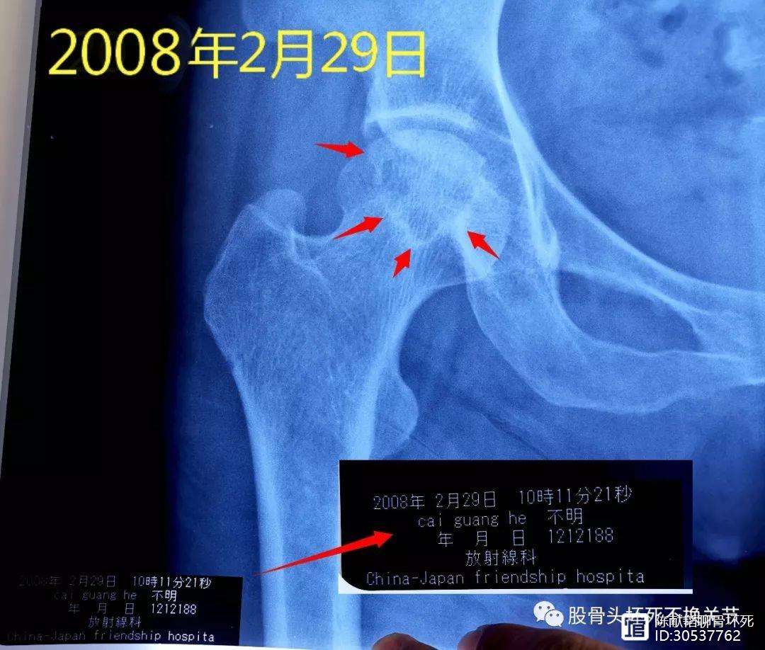 吉林人工骨头医保报销多少(人工骨头医保报销多少比例)